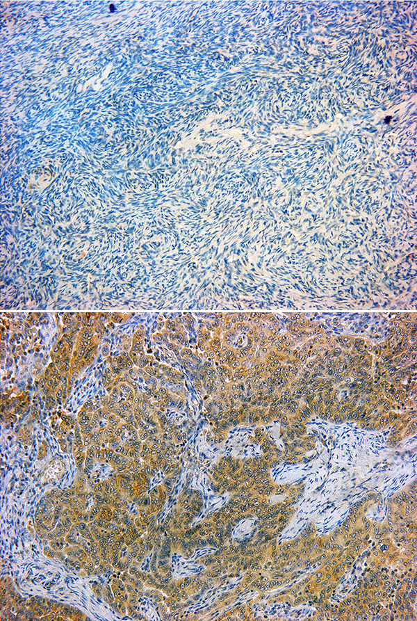 Das obere Bild zeigt das menschliche Eierstockgewebe: Die blauen Färbungen repräsentieren die einzelnen Zellkerne. Die braune Färbung auf dem unteren Bild zeigt die Aktivierung eines Genes der endogenen Retroviren an. (Bild: PD Dr. Strissel/PD Dr. Reiner Strick)
