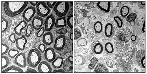 Eine elektronenmikroskopische Aufnahme eines Ischias-Nerv.